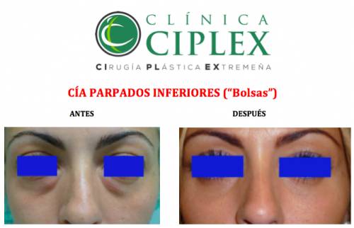 Blefaroplastia